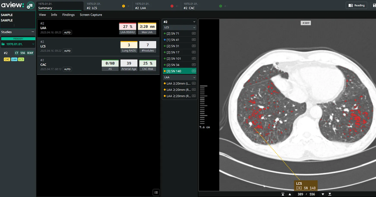 Interface of Coreline Soft's AI-powered chest X-ray analysis software