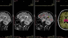 Automatic MRI scan analysis report generated by SNAC's AI-based platform iQ-solutions