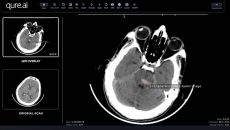 
   Interface of the Qure.ai qER software
