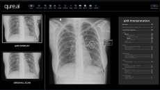 
  Qure.ai's qXR software for the detection of abnormalities in chest x-rays
