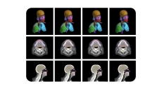 
  An image from the radiotherapy planning model developed by Google and the Mayo Clinic.

