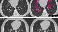 cystic fibrosis, Thirona