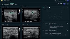A screenshot of a breast scan reading from the See-Mode software