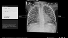 Paediatric chest X-ray scan analysis