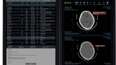 Desktop view of the Qure.ai Stroke Management Platform