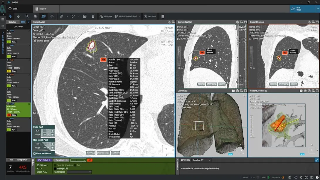 Coreline Soft's flagship product, AVIEW LCS, an AI-powered automatic pulmonary nodule analysis solution
