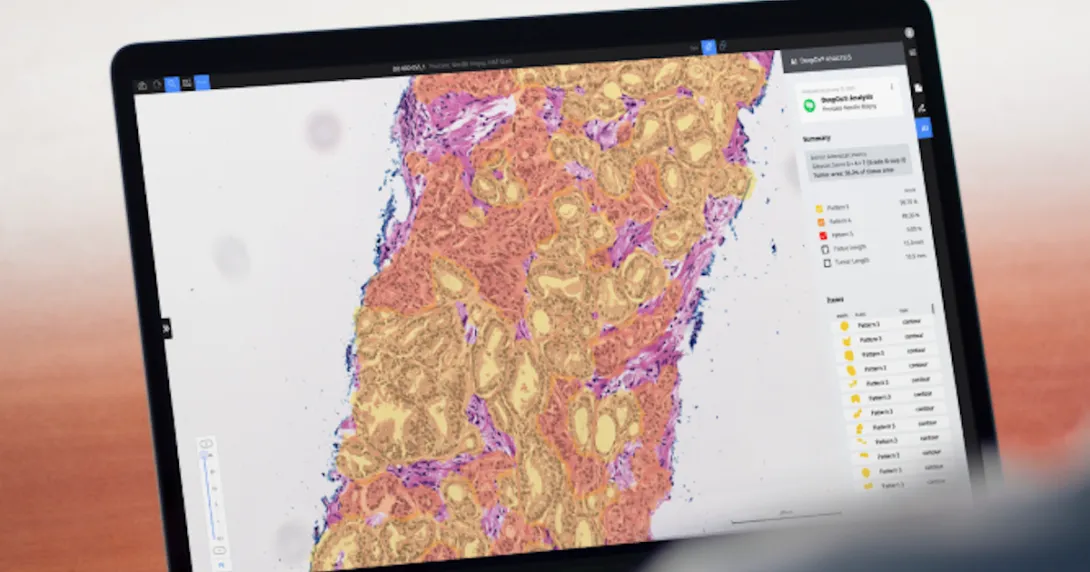 Deep Bio's prostate cancer analysis AI Deep Bio's prostate cancer analysis AI