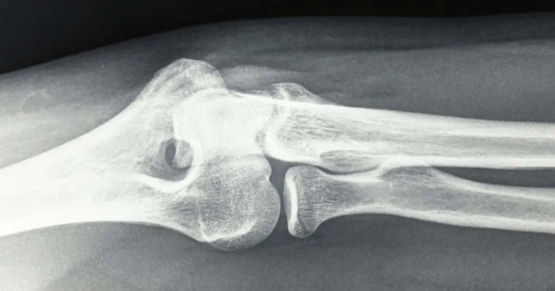 X-ray image
X-ray image