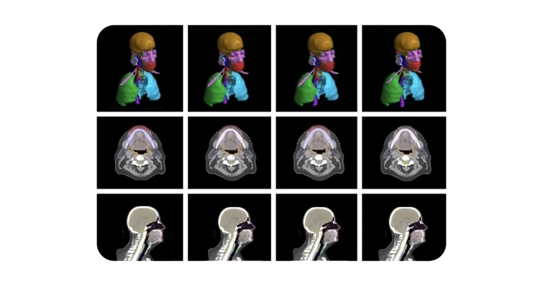 An image from the radiotherapy planning model developed by Google and the Mayo Clinic.
An image from the radiotherapy planning model developed by Google and the Mayo Clinic.