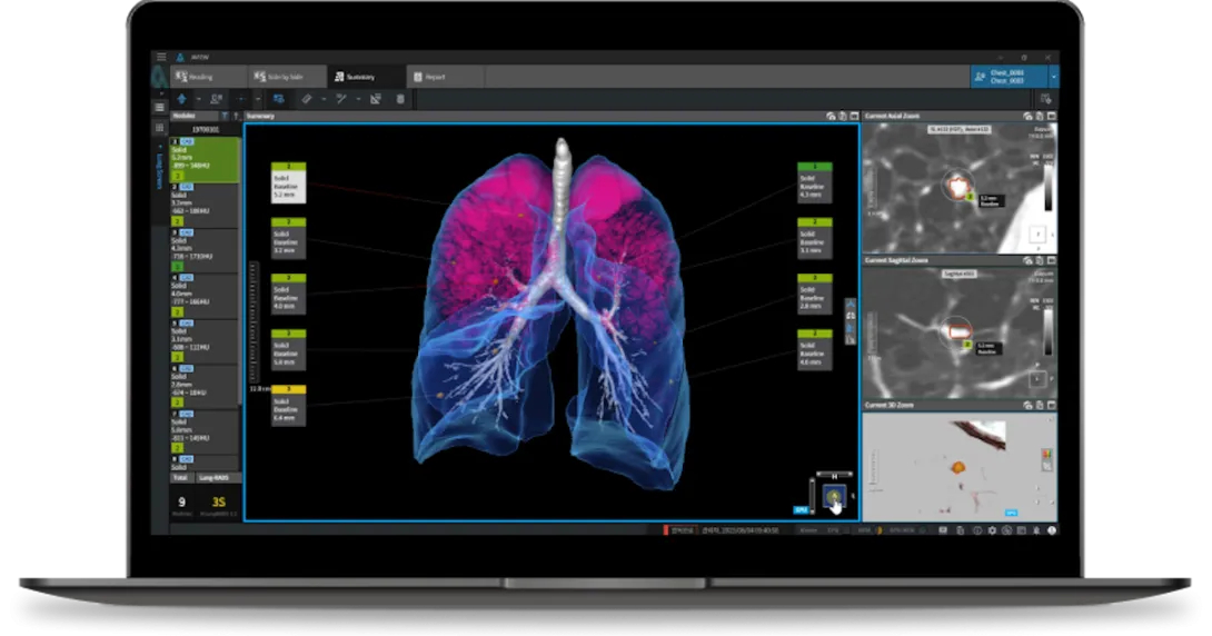 Interface of Coreline Soft's lung cancer imaging AI software Interface of Coreline Soft's lung cancer imaging AI software