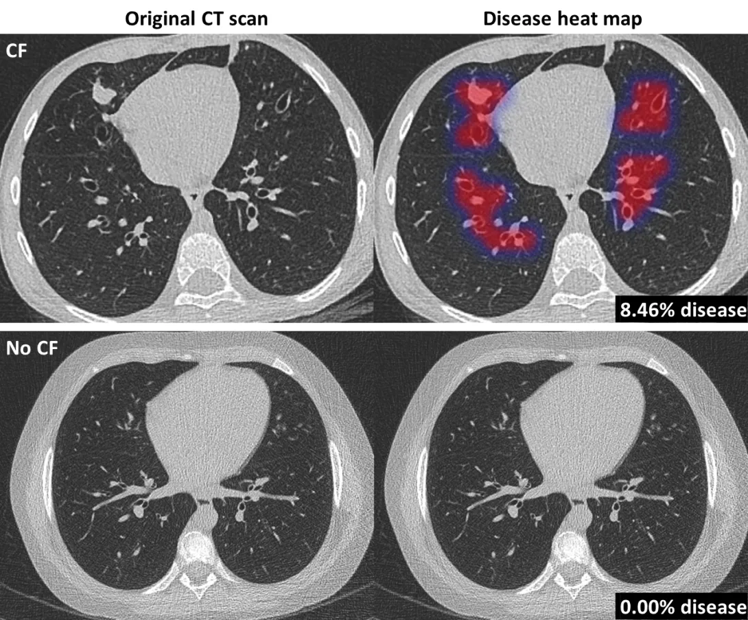 The new algorithm allows for automated analysis of CT scans of patients with the condition. cystic fibrosis, Thirona