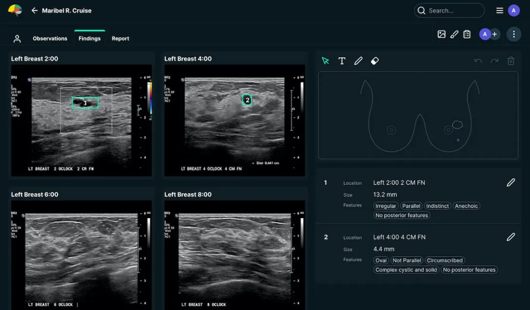 A screenshot of a breast scan reading from the See-Mode software