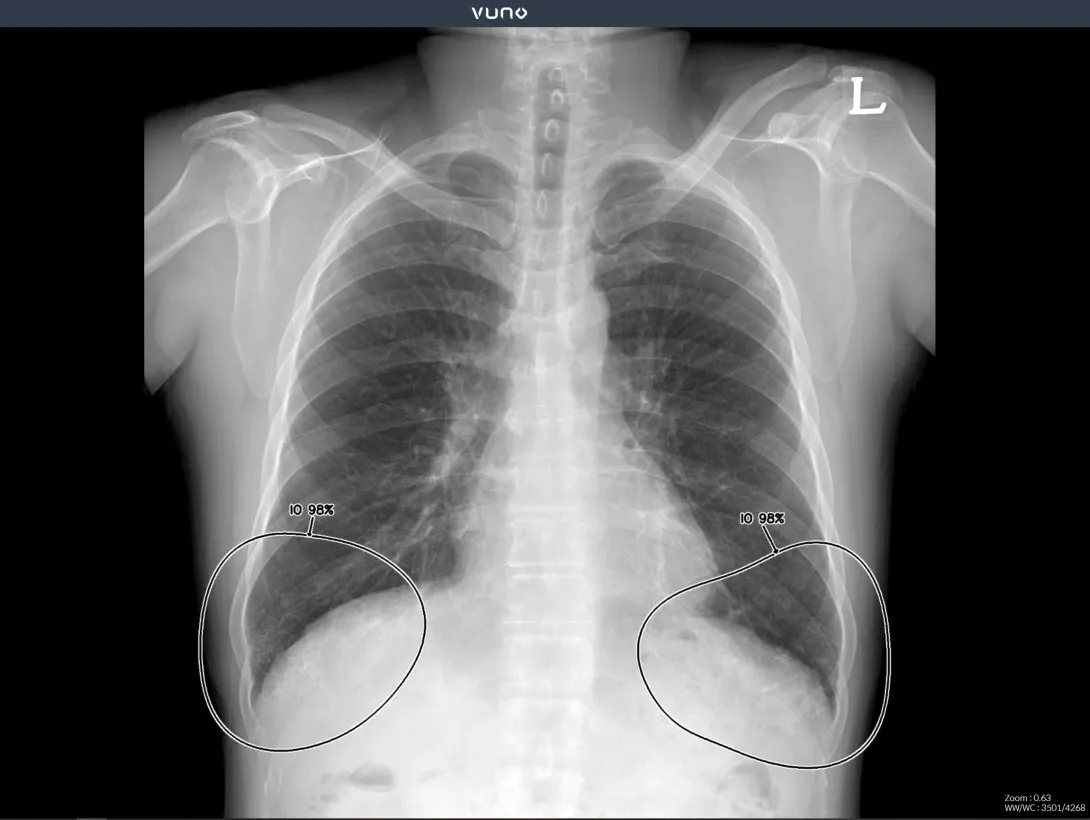 An X-ray scan from Vuno's Med-Chest X-Ray solution.