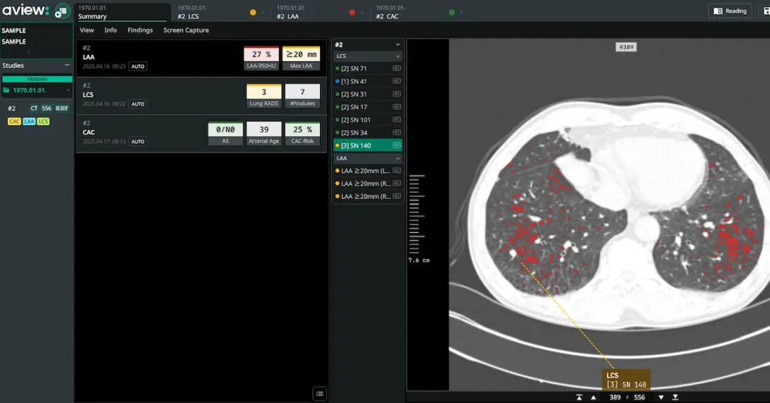 An interface of Coreline Soft's lung cancer screening analysis software