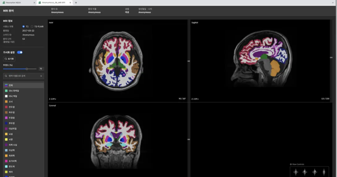 Neurophet's brain MRI scan analysis AI software shown on a desktop monitor