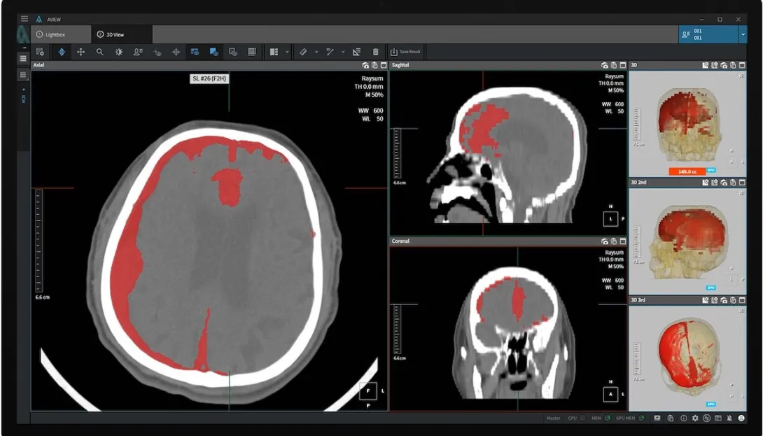 Interface of Coreline Soft's AVIEW Neuro CAD
